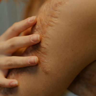 Scar Therapy Arm Scar Therapy Arm